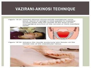 VAZIRANI-AKINOSI TECHNIQUE
 
