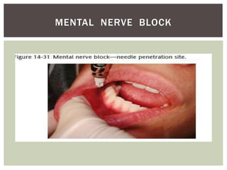 MENTAL NERVE BLOCK
 