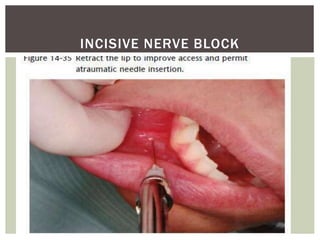 INCISIVE NERVE BLOCK
 