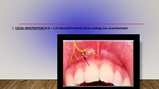 LOCAL ANAESTHESIA classification, contents , indication and ...