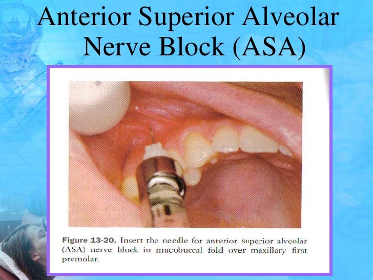 Local anaesthesia and techniques for pedodontics