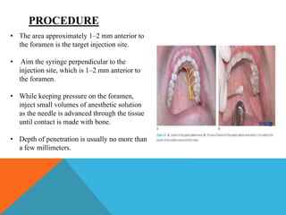 Local anaesthesia blocks in ent | PPTX