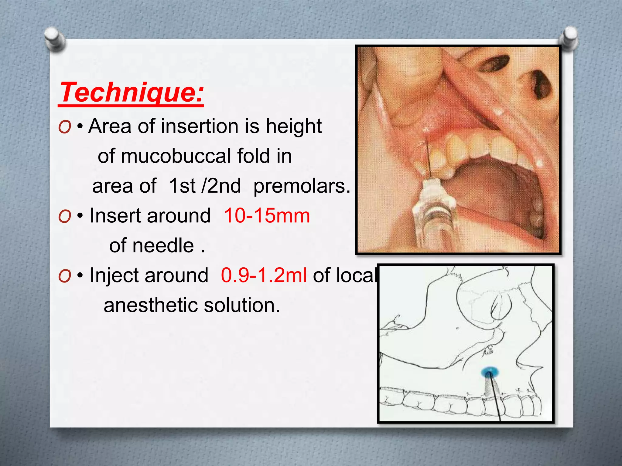 Technique:
O • Area of insertion is height
of mucobuccal fold in
area of 1st /2nd premolars.
O • Insert around 10-15mm
of needle .
O • Inject around 0.9-1.2ml of local
anesthetic solution.
 