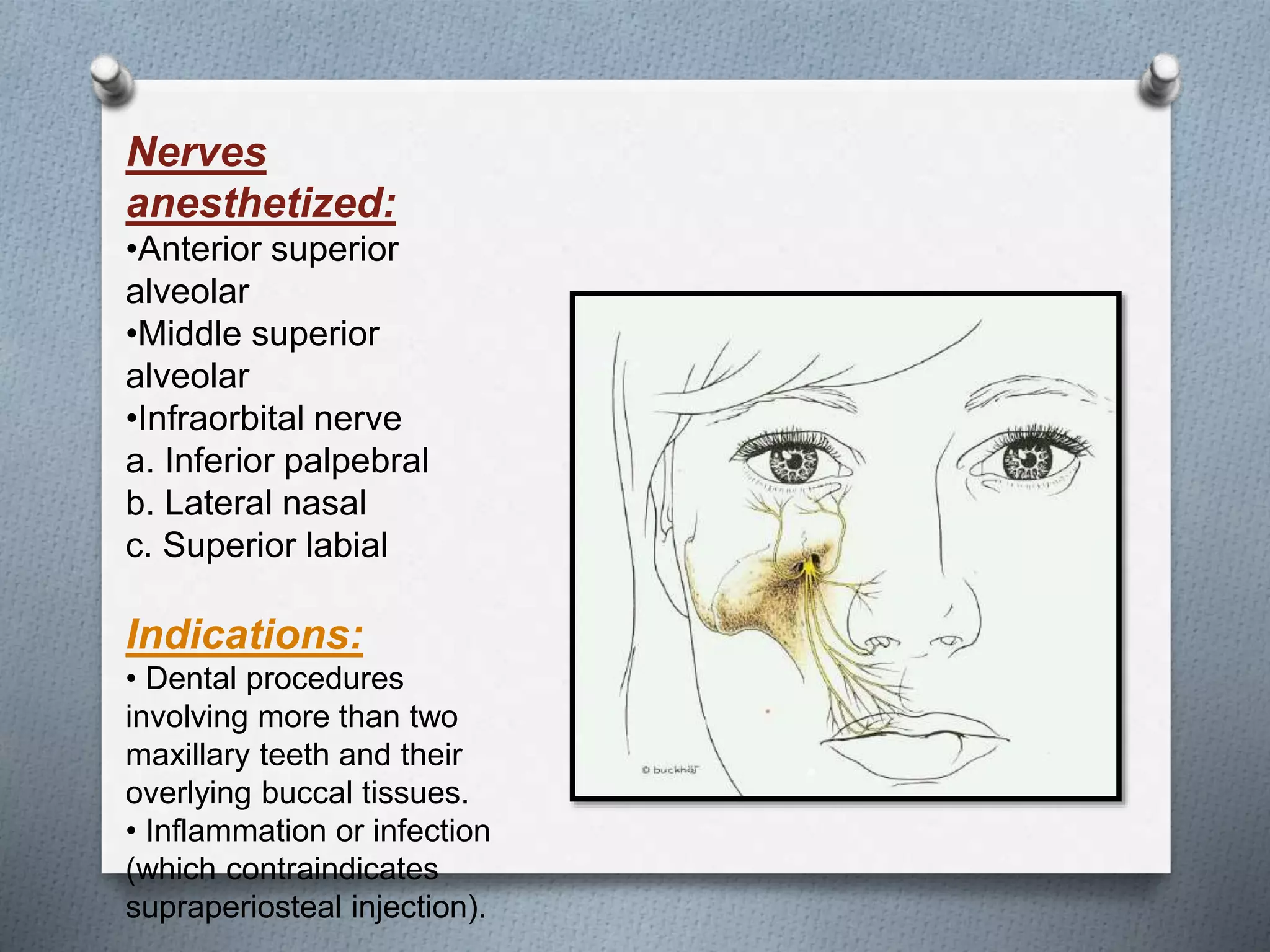 Nerves
anesthetized:
•Anterior superior
alveolar
•Middle superior
alveolar
•Infraorbital nerve
a. Inferior palpebral
b. Lateral nasal
c. Superior labial
Indications:
• Dental procedures
involving more than two
maxillary teeth and their
overlying buccal tissues.
• Inflammation or infection
(which contraindicates
supraperiosteal injection).
 