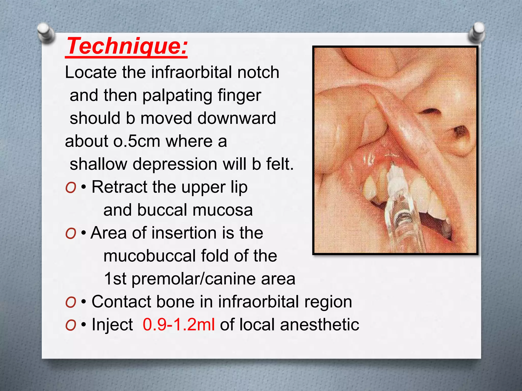 Technique:
Locate the infraorbital notch
and then palpating finger
should b moved downward
about o.5cm where a
shallow depression will b felt.
O • Retract the upper lip
and buccal mucosa
O • Area of insertion is the
mucobuccal fold of the
1st premolar/canine area
O • Contact bone in infraorbital region
O • Inject 0.9-1.2ml of local anesthetic
 