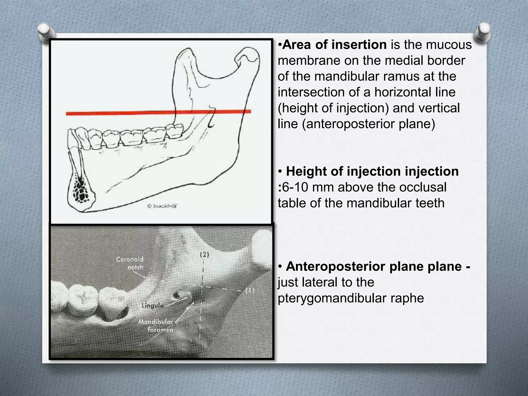 •Area of insertion is the mucous
membrane on the medial border
of the mandibular ramus at the
intersection of a horizontal line
(height of injection) and vertical
line (anteroposterior plane)
• Height of injection injection
:6-10 mm above the occlusal
table of the mandibular teeth
• Anteroposterior plane plane -
just lateral to the
pterygomandibular raphe
 