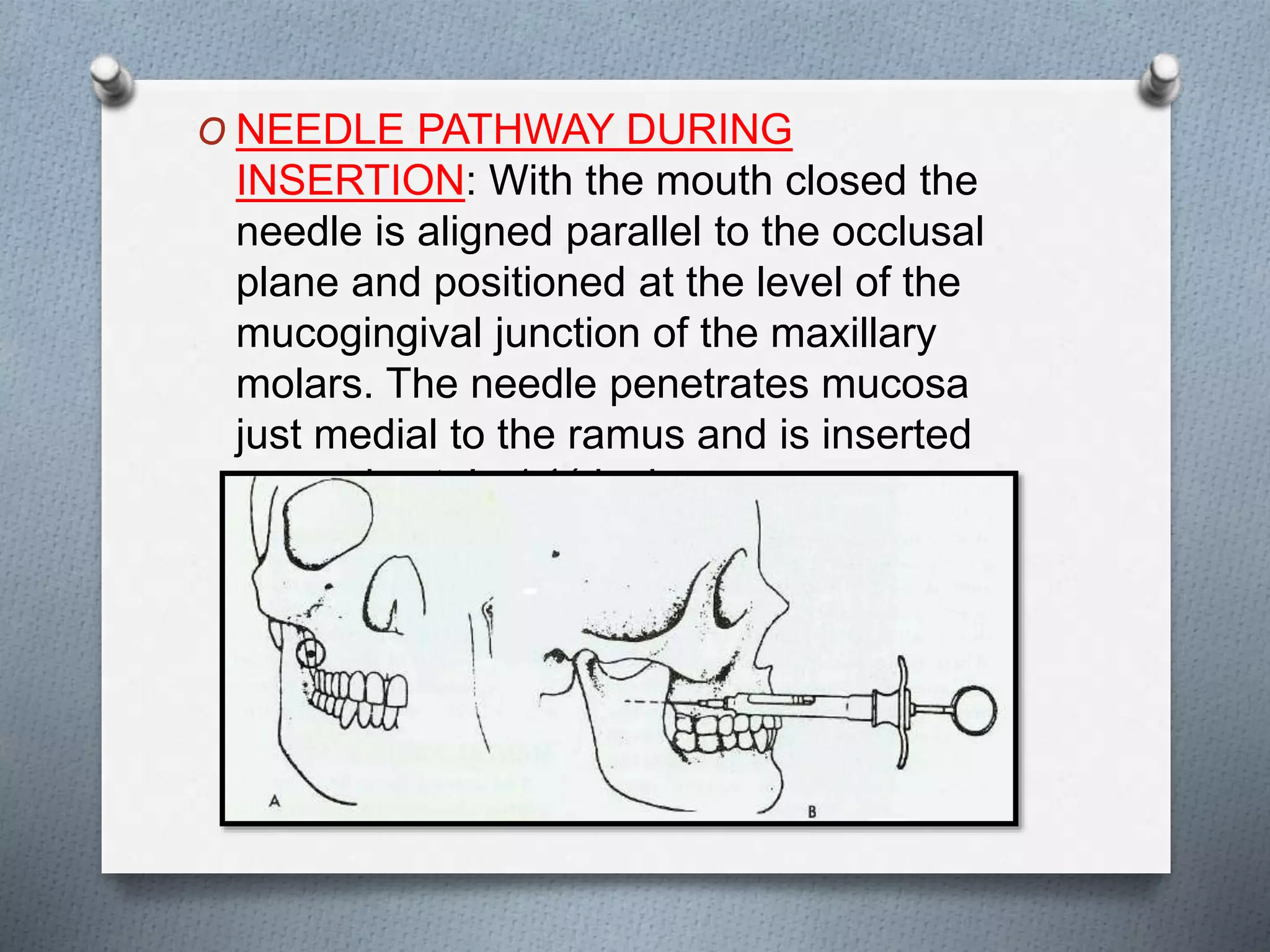 O NEEDLE PATHWAY DURING
INSERTION: With the mouth closed the
needle is aligned parallel to the occlusal
plane and positioned at the level of the
mucogingival junction of the maxillary
molars. The needle penetrates mucosa
just medial to the ramus and is inserted
approximately 1 ¼ inches.
 