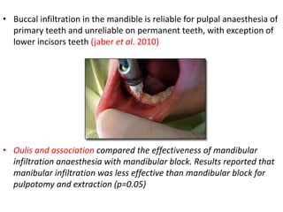 • Buccal infiltration in the mandible is reliable for pulpal anaesthesia of
primary teeth and unreliable on permanent teeth, with exception of
lower incisors teeth (jaber et al. 2010)
• Oulis and association compared the effectiveness of mandibular
infiltration anaesthesia with mandibular block. Results reported that
manibular infiltration was less effective than mandibular block for
pulpotomy and extraction (p=0.05)
 
