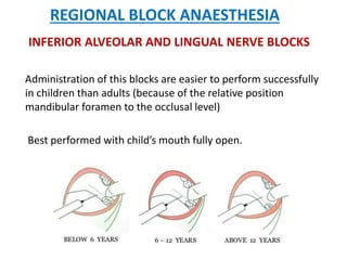REGIONAL BLOCK ANAESTHESIA
INFERIOR ALVEOLAR AND LINGUAL NERVE BLOCKS
Administration of this blocks are easier to perform successfully
in children than adults (because of the relative position
mandibular foramen to the occlusal level)
Best performed with child’s mouth fully open.
 