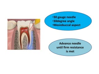 •30 gauge needle
•30degree angle
•Mesiobuccal aspect
Advance needle
until firm resistance
is met
 