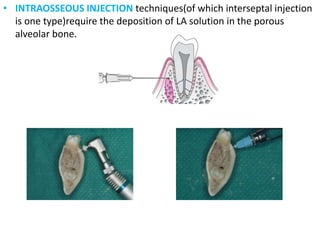 • INTRAOSSEOUS INJECTION techniques(of which interseptal injection
is one type)require the deposition of LA solution in the porous
alveolar bone.
 