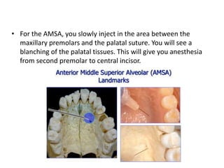 • For the AMSA, you slowly inject in the area between the
maxillary premolars and the palatal suture. You will see a
blanching of the palatal tissues. This will give you anesthesia
from second premolar to central incisor.
 