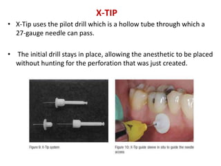 • X-Tip uses the pilot drill which is a hollow tube through which a
27-gauge needle can pass.
• The initial drill stays in place, allowing the anesthetic to be placed
without hunting for the perforation that was just created.
X-TIP
 