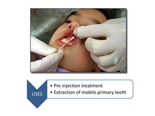 USES
• Pre injection treatment
• Extraction of mobile primary teeth
 