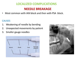 LOCALIZED COMPLICATIONS
NEEDLE BREAKAGE
• Most common with IAN block and then with PSA block.
CAUSES
1. Weakening of needle by bending
2. Unexpected movements by patient
3. Smaller gauge needles
 