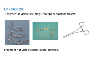 MANAGEMENT
Fragment is visible use magill forceps or small hemostat.
Fragment not visible consult a oral surgeon.
 