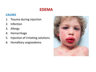EDEMA
CAUSES
1. Trauma during injection
2. Infection
3. Allergy
4. Hemorrhage
5. Injection of irritating solutions
6. Hereditary angioedema
 