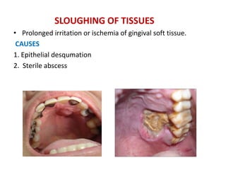 SLOUGHING OF TISSUES
• Prolonged irritation or ischemia of gingival soft tissue.
CAUSES
1. Epithelial desqumation
2. Sterile abscess
 