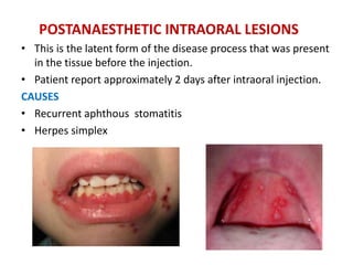 POSTANAESTHETIC INTRAORAL LESIONS
• This is the latent form of the disease process that was present
in the tissue before the injection.
• Patient report approximately 2 days after intraoral injection.
CAUSES
• Recurrent aphthous stomatitis
• Herpes simplex
 
