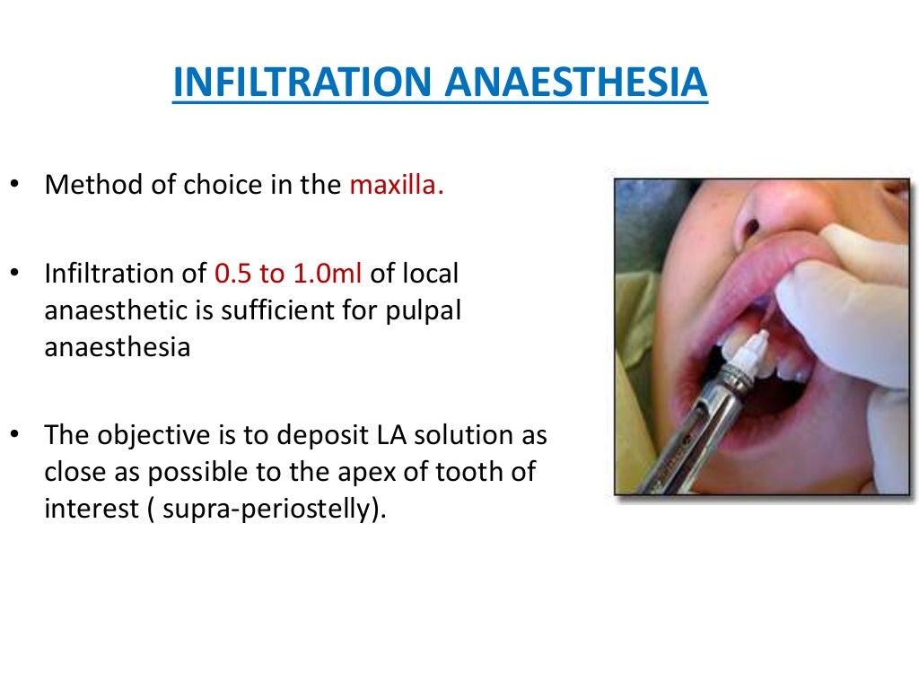 Local anaesthesia for children (dentistry)