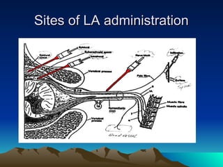 Sites of LA administration
Sites of LA administration
 