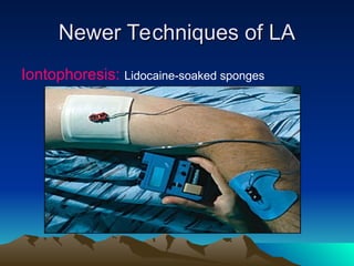 Newer Techniques of LA
Newer Techniques of LA
Iontophoresis: Lidocaine-soaked sponges
 