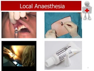Local Anaesthesia

3

 