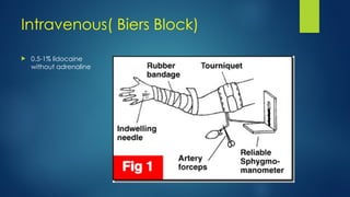 Biers Block Risks LOCAL... easter amide ...ANASTHESIA.pptx