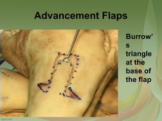 Triangular Flao Local flaps in head & neack reconstruction | PPT