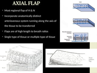 LOCAL AND REGIONAL FLAPS IN ORAL SURGERY.pptx