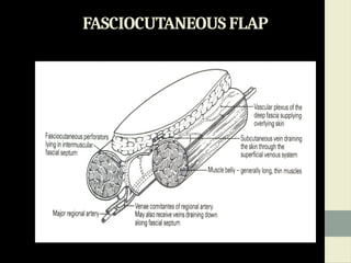 LOCAL AND REGIONAL FLAPS IN ORAL SURGERY.pptx