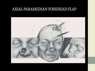 LOCAL AND REGIONAL FLAPS IN ORAL SURGERY.pptx
