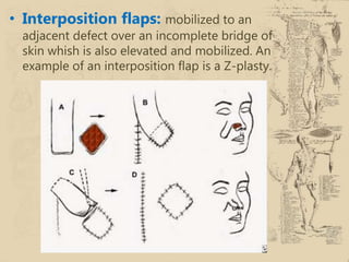 Interposition Flap Local and regional flaps in head and neck reconstruction | PPTX