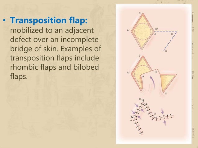 Regional Flaps: A Move To Simpler Reconstructive Options In – ZHERSS