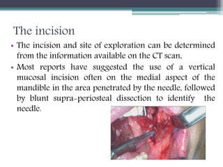 Local and systemic complications of local anesthesia | PPTX