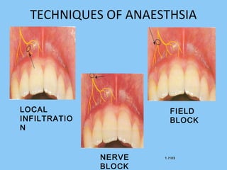 1 /1031 /103
TECHNIQUES OF ANAESTHSIA
LOCAL
INFILTRATIO
N
FIELD
BLOCK
NERVE
BLOCK
 