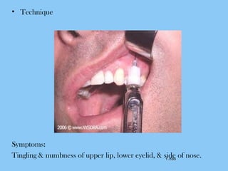 1 /1031 /103
• Technique
Symptoms:
Tingling & numbness of upper lip, lower eyelid, & side of nose.
 