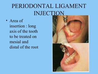 1 /1031 /103
PERIODONTAL LIGAMENT
INJECTION
• Area of
insertion : long
axis of the tooth
to be treated on
mesial and
distal of the root
 