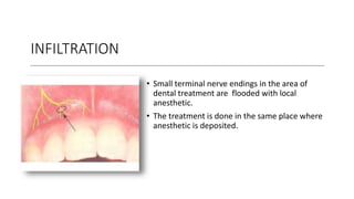 INFILTRATION
• Small terminal nerve endings in the area of
dental treatment are flooded with local
anesthetic.
• The treatment is done in the same place where
anesthetic is deposited.
 