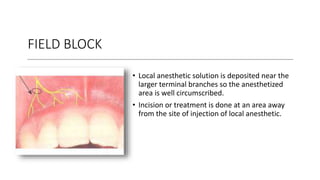 FIELD BLOCK
• Local anesthetic solution is deposited near the
larger terminal branches so the anesthetized
area is well circumscribed.
• Incision or treatment is done at an area away
from the site of injection of local anesthetic.
 