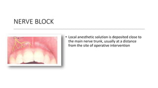 NERVE BLOCK
• Local anesthetic solution is deposited close to
the main nerve trunk, usually at a distance
from the site of operative intervention
 