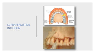 SUPRAPERIOSTEAL
INJECTION
 