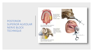 POSTERIOR
SUPERIOR ALVEOLAR
NERVE BLOCK
TECHNIQUE
 