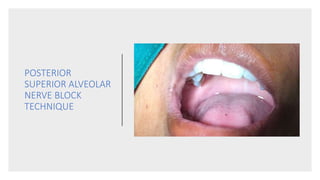 POSTERIOR
SUPERIOR ALVEOLAR
NERVE BLOCK
TECHNIQUE
 