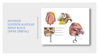 ANTERIOR
SUPERIOR ALVEOLAR
NERVE BLOCK
(INFRA ORBITAL)
 