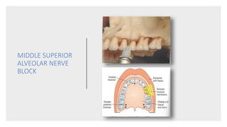 MIDDLE SUPERIOR
ALVEOLAR NERVE
BLOCK
 