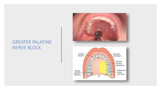 GREATER PALATINE
NERVE BLOCK
 