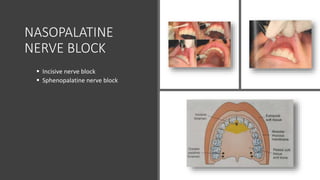 NASOPALATINE
NERVE BLOCK
 Incisive nerve block
 Sphenopalatine nerve block
 