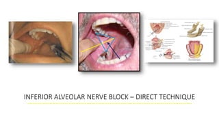 INFERIOR ALVEOLAR NERVE BLOCK – DIRECT TECHNIQUE
 