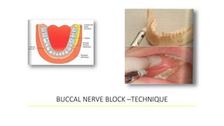 BUCCAL NERVE BLOCK –TECHNIQUE
 